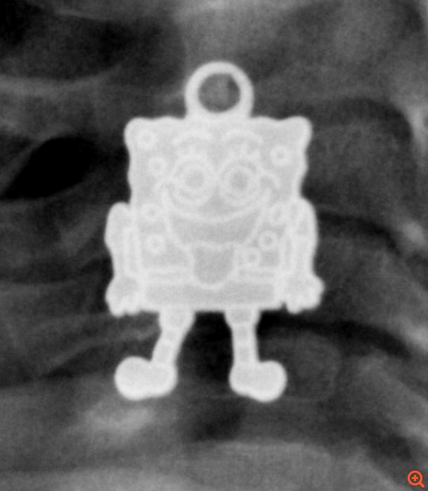 κατάποση ξένου σώματος 3 7/9/15