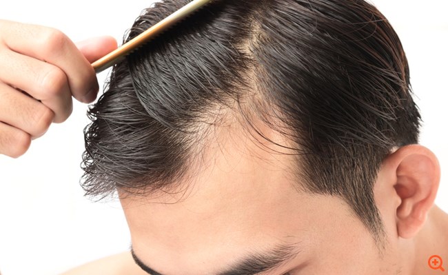 άντρας μαλλιά τριχόπτωση 11/4/17