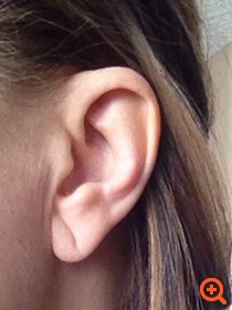 Τι σχέση έχει η στεφανιαία νόσος με το λοβό του αφτιού σας;