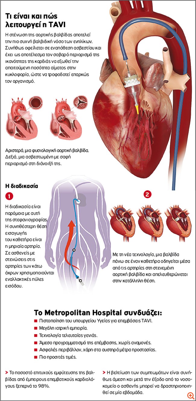 Metropolitan Hospital: Αντικατάσταση αορτικής βαλβίδας (TAVI) χωρίς διάνοιξη του θώρακα