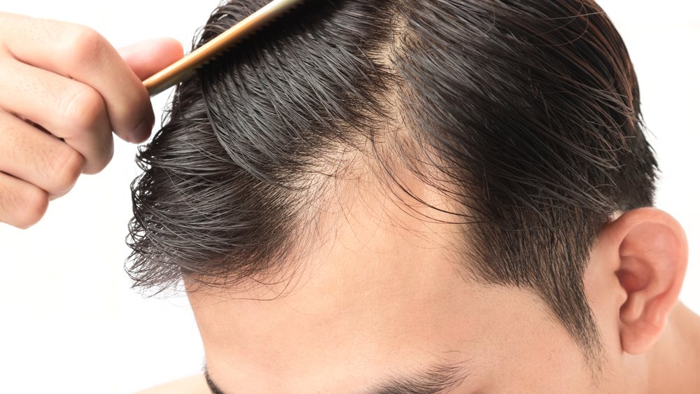 Εποχιακή τριχόπτωση: Τι είναι και τι μπορείτε να κάνετε