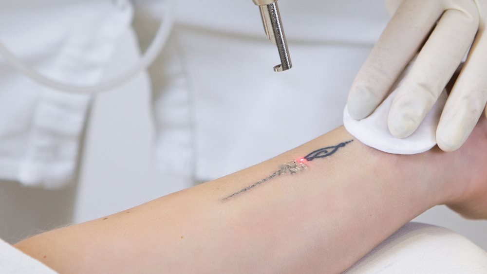Αφαίρεση τατουάζ με LASER: 2 βασικά σημεία που πρέπει να γνωρίζετε προτού το μετανιώσετε