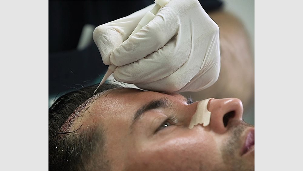 Seneca Medical Group: 35 χρόνια εμπειρίας στις μεταμοσχεύσεις μαλλιών