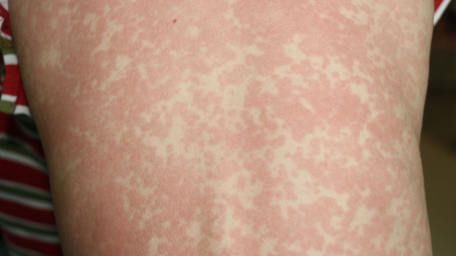 ΠΟΥ: Αύξηση κατά 79% των κρουσμάτων ιλαράς παγκοσμίως το 2023