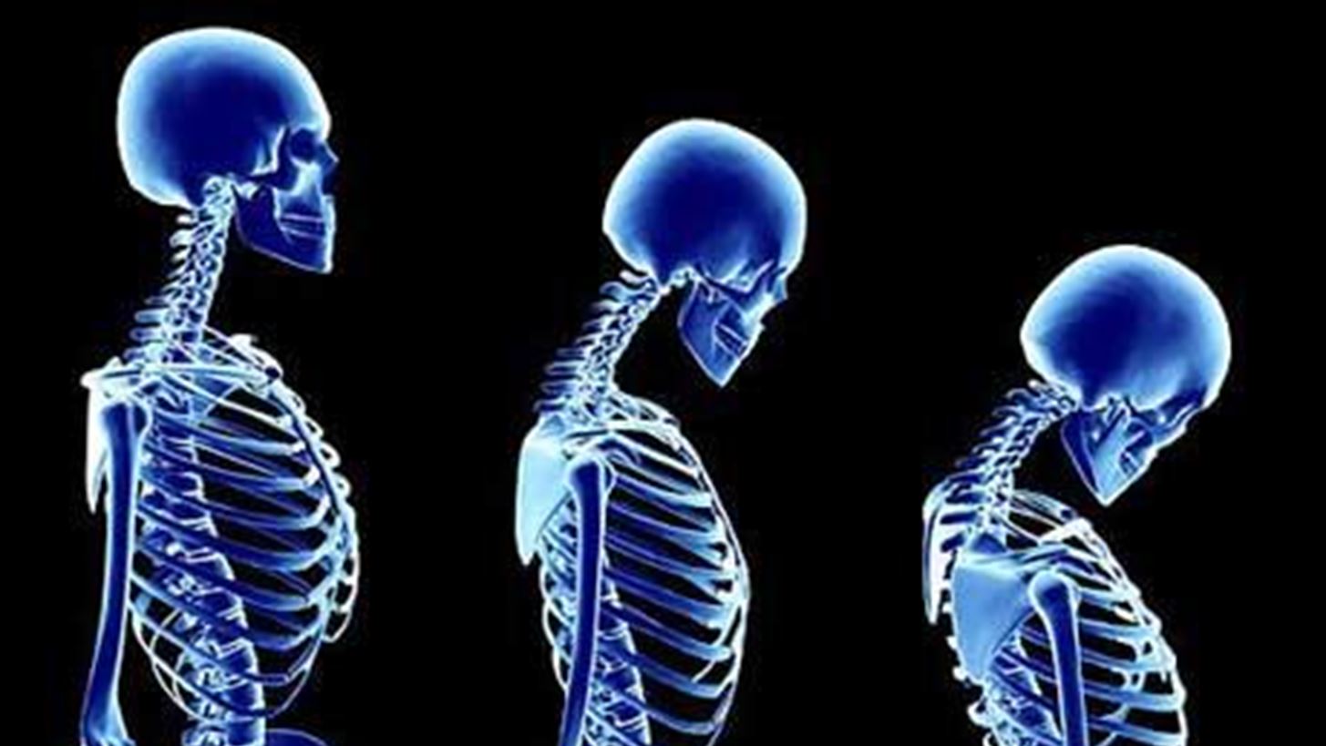 Παγκόσμια Ημέρα Οστεοπόρωσης: Σήμερα υπάρχει λύση