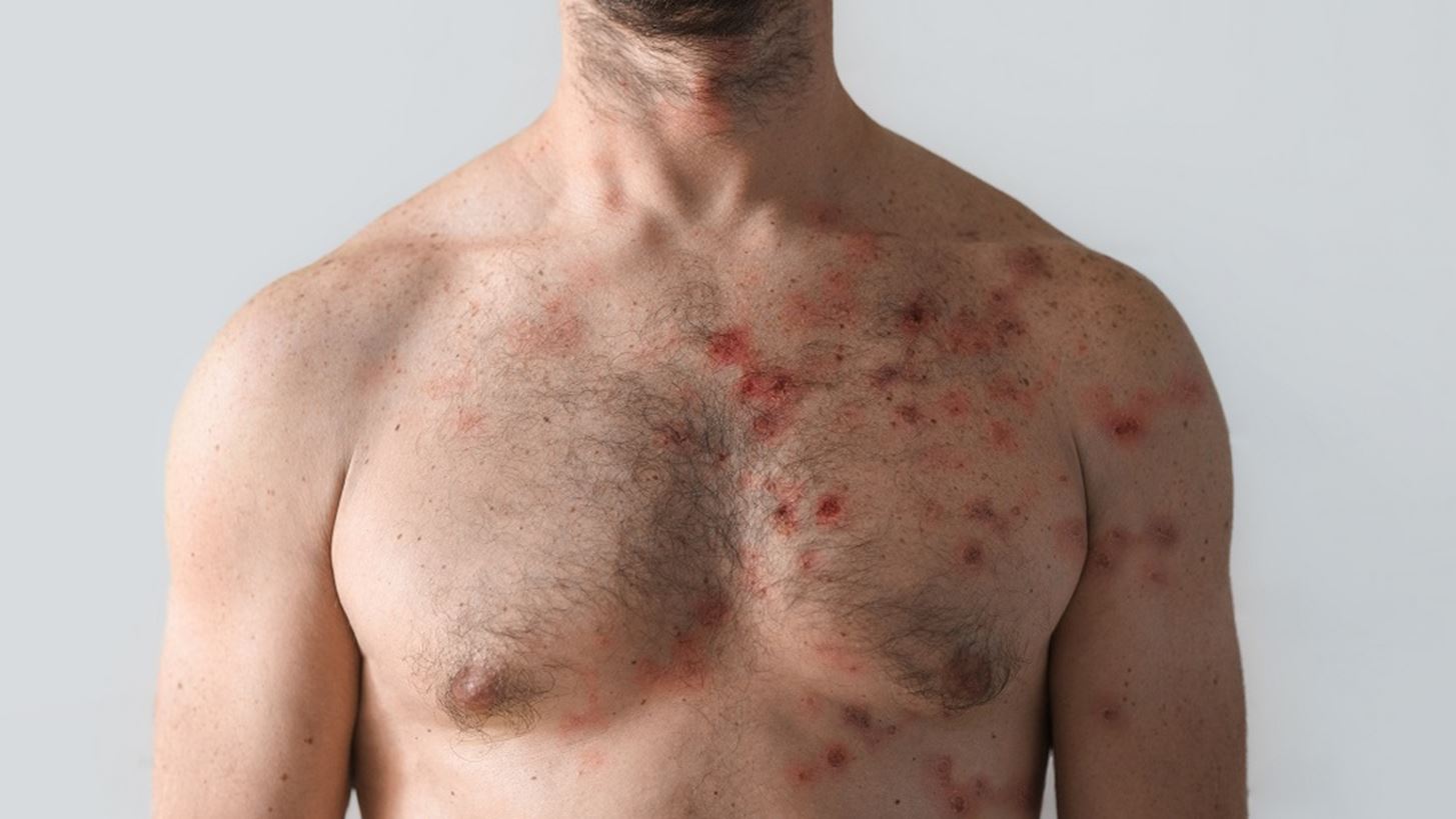 Ποια είναι τα συχνότερα συμπτώματα της ευλογιάς των πιθήκων