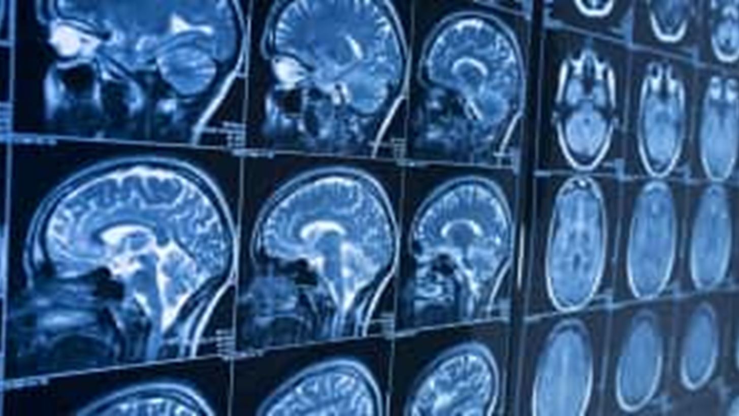 Αλτσχάιμερ: Ελπιδοφόρo φάρμακο από φύκια δοκιμάζεται σε 3η φάση κλινικών δοκιμών