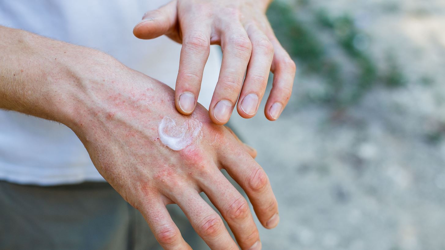 Ψωρίαση και στρες: Γιατί είναι σημαντικό να σπάσει ο φαύλος κύκλος