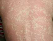 ΠΟΥ: Αύξηση κατά 79% των κρουσμάτων ιλαράς παγκοσμίως το 2023