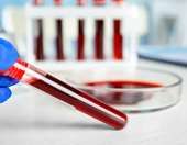 Πώς ανεβαίνει ο χαμηλός αιματοκρίτης;