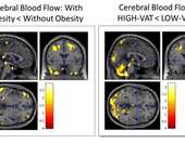 Το κρυμμένο λίπος "προβλέπει" το Αλτσχάιμερ 20 χρόνια πριν από την εμφάνιση των πρώτων συμπτωμάτων