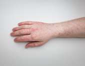 ΕΟΔΥ: Υψηλή η πιθανότητα εμφάνισης και άλλων κρουσμάτων ιλαράς