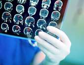 Ο ρόλος των εφαρμογών Τεχνητής Νοημοσύνης στην αντιμετώπιση οξέων αγγειακών εγκεφαλικών επεισοδίων (ΑΕΕ)