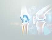 Α. Αγγουλές: Ποια άσκηση ενδείκνυται για πρόληψη και θεραπεία της οστεοπόρωσης