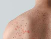 ΠΟΥ: Η Ευλογιά των Πιθήκων δεν είναι η νέα covid, δήλωσε στέλεχος του Παγκόσμιου Οργανισμού Υγείας