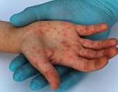 ΗΠΑ: Φόβος για μια υγειονομική καταστροφή λόγω της επιφυλακτικότητας έναντι των εμβολίων