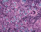 Γυρίζοντας έναν διακόπτη, ο καρκίνος αυτοκαταστρέφεται