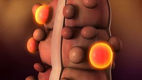 Γιατί θερίζει ο καρκίνος του παχέος εντέρου