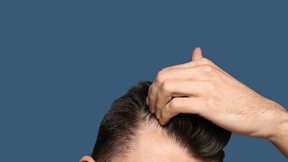 Γιατί δεν αρκούν οι βιταμίνες για την αντιμετώπιση της τριχόπτωσης;