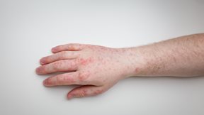 ΕΟΔΥ: Υψηλή η πιθανότητα εμφάνισης και άλλων κρουσμάτων ιλαράς