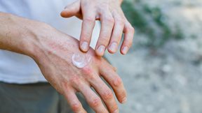 Ψωρίαση και στρες: Γιατί είναι σημαντικό να σπάσει ο φαύλος κύκλος