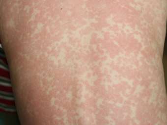 ΠΟΥ: Αύξηση κατά 79% των κρουσμάτων ιλαράς παγκοσμίως το 2023