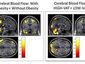 Το κρυμμένο λίπος "προβλέπει" το Αλτσχάιμερ 20 χρόνια πριν από την εμφάνιση των πρώτων συμπτωμάτων