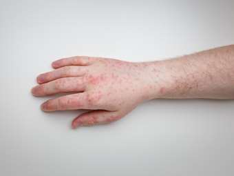 Καναδάς: Παιδί πέθανε από ιλαρά στο Οντάριο, για πρώτη φορά από το 2013