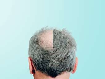 Νέα εποχή στη µεταµόσχευση µακριών µαλλιών