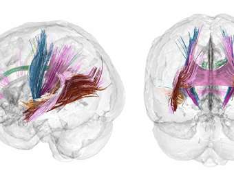 Eρευνητές δημιουργούν χάρτες για τις αλλαγές στον εγκέφαλο κατά την εγκυμοσύνη