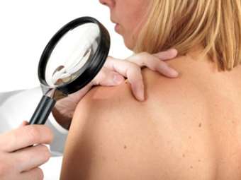 Πρώτη φορά στην Ελλάδα εμβόλιο mRNA κατά του δερματικού μελανώματος