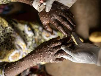 Έκκληση για διεθνή βοήθεια από τη Σιέρα Λεόνε - Πασχίζει να θέσει υπό έλεγχο επιδημία ευλογιάς των πιθήκων