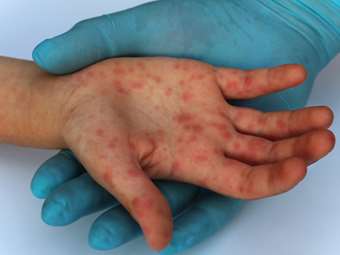 ΗΠΑ: Φόβος για μια υγειονομική καταστροφή λόγω της επιφυλακτικότητας έναντι των εμβολίων