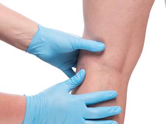 Αντίο Κιρσοί: Μια Σύγχρονη &amp; Αποτελεσματική Λύση Θεραπείας