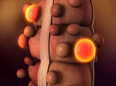 Όταν ο καρκίνος του παχέος εντέρου "χτυπάει" νωρίς: Ποιοι διατρέχουν μεγαλύτερο κίνδυνο