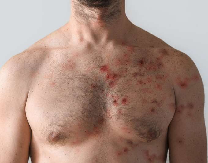 Ευλογιά των πιθήκων: Πώς μπορούμε να προστατευτούμε από τη νόσο;